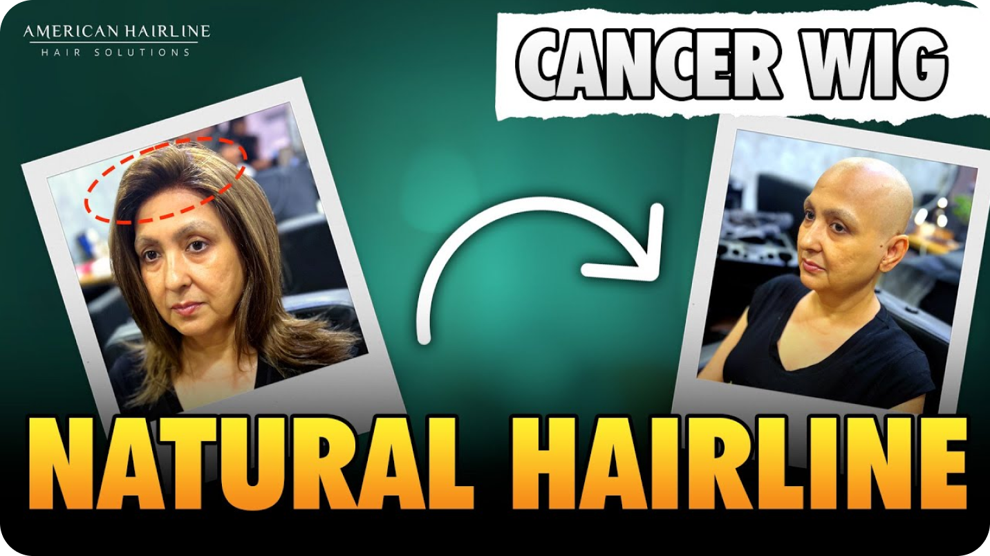 Natural hairline